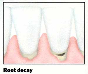 adult tooth decay 2