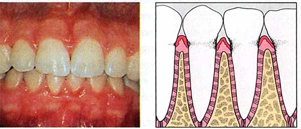 treat gingivitis