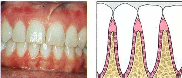 treat normal gums